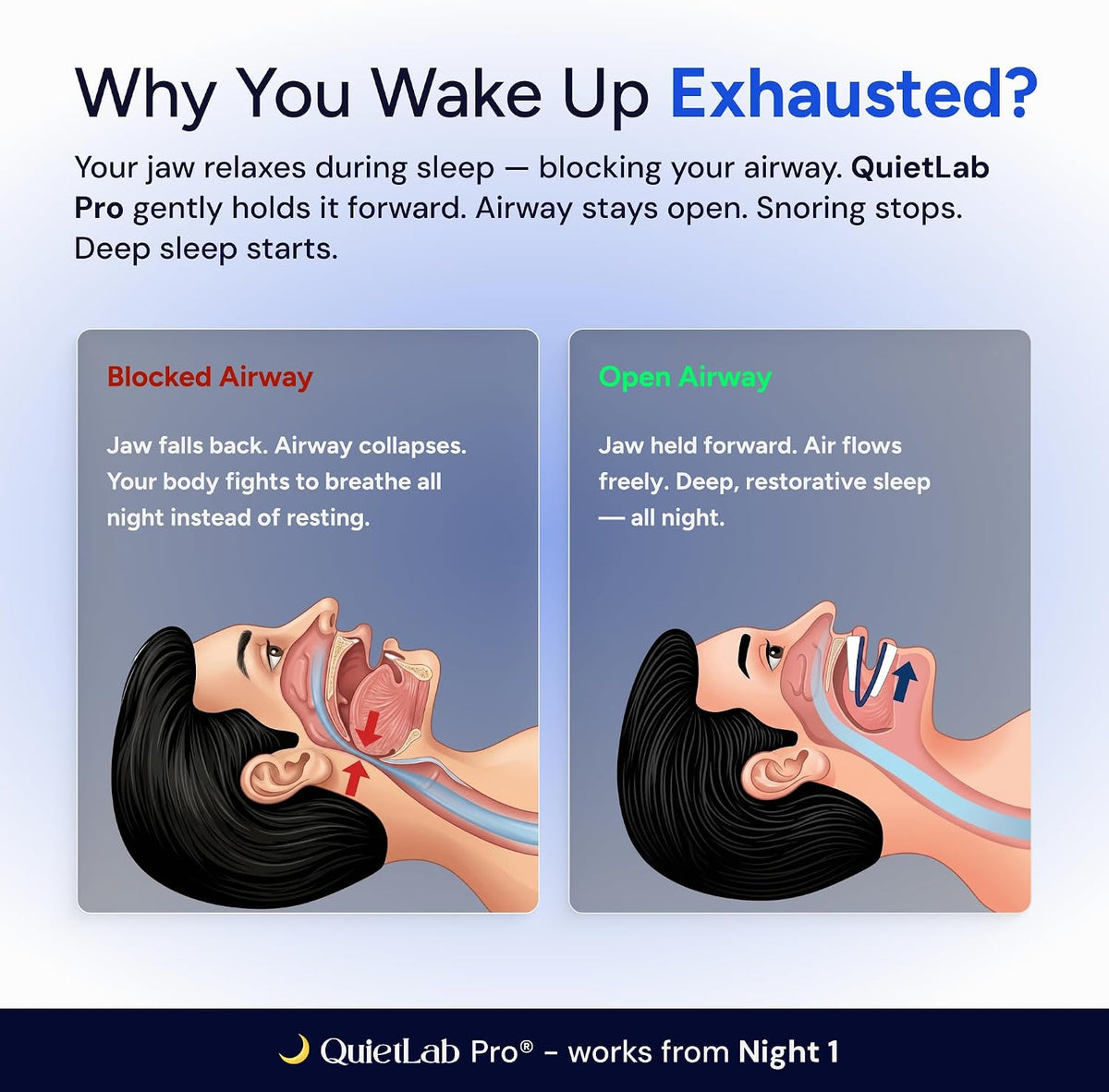 QUIETLAB® Mouth Guard for Sleeping - Anti-Snoring Device, Custom Fit